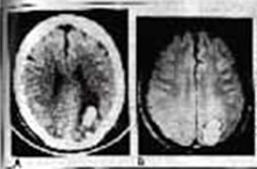 L. Weisberg, D. Elliott, and D. Mielke: Intracerebral Hemorrhage Follwoing Electroconvulsive Therapy (ECT), Nov. 1993, Neurology V 41 p 1849